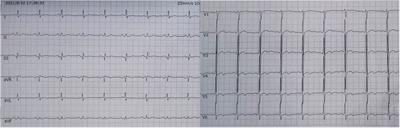 Acute pulmonary embolism combined with acute myocardial infarction as the first manifestation of acute leukemia: a case report